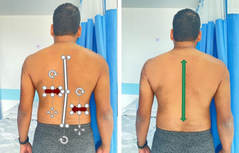 Restoration of normal spinal curve within 3 days